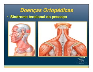 • Síndrome tensional do pescoço• Síndrome tensional do pescoço
Doenças OrtopédicasDoenças Ortopédicas
 