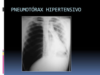 PNEUMOTÓRAX HIPERTENSIVO
 