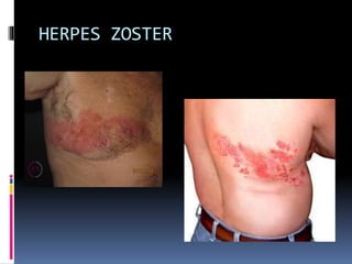 HERPES ZOSTER
 