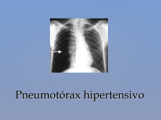 Pneumotórax hipertensivoPneumotórax hipertensivo
 