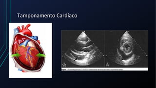 Tamponamento Cardíaco
 