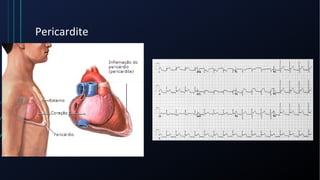Pericardite
 