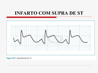 INFARTO COM SUPRA DE ST 