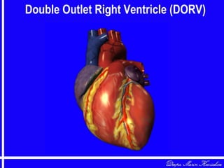 Double Outlet Right Ventricle (DORV)
 
