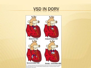 VSD IN DORV
 
