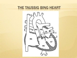 THE TAUSSIG BING HEART
 