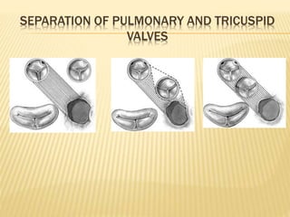 SEPARATION OF PULMONARY AND TRICUSPID
VALVES
 