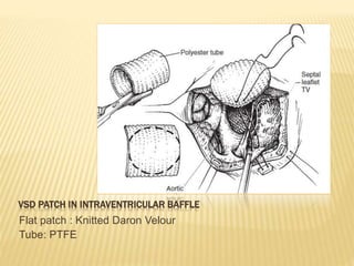 VSD PATCH IN INTRAVENTRICULAR BAFFLE
Flat patch : Knitted Daron Velour
Tube: PTFE
 