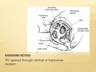 KAWASHIMA METHOD
RV opened through vertical or transverse
incision
 