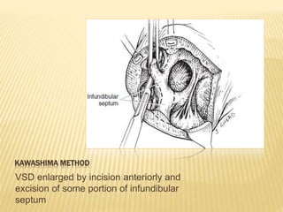 KAWASHIMA METHOD
VSD enlarged by incision anteriorly and
excision of some portion of infundibular
septum
 