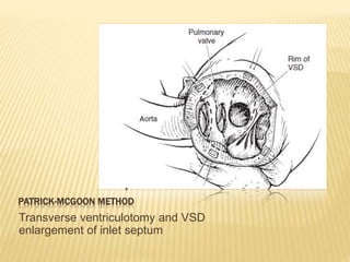 PATRICK-MCGOON METHOD
Transverse ventriculotomy and VSD
enlargement of inlet septum
 