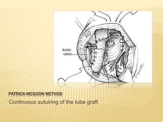 PATRICK-MCGOON METHOD
Continuous sutuiring of the tube graft
 