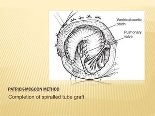 PATRICK-MCGOON METHOD
Completion of spiralled tube graft
 