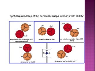 spatial relationship of the semilunar cusps in hearts with DORV
Guideline DORV
 