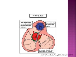 Guideline DORV
Definition
Mahle WT et al. Cardiol Young 2008; 18(Suppl. 3): 39–51
> 150 % rule
 