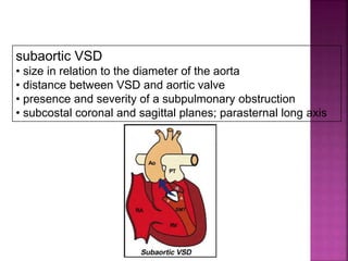 subaortic VSD
• size in relation to the diameter of the aorta
• distance between VSD and aortic valve
• presence and severity of a subpulmonary obstruction
• subcostal coronal and sagittal planes; parasternal long axis
Guideline DORV
subaortic VSD
 