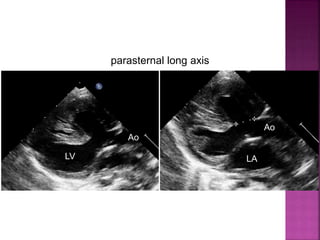 Guideline DORV
subaortic VSD
parasternal long axis
Ao
Ao
LV LA
 