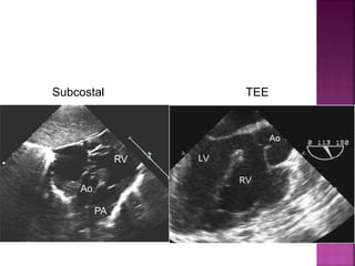 Guideline DORV
subaortic VSD
Subcostal TEE
Ao
RV
PA
 