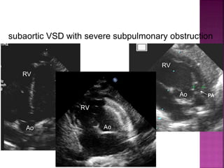 RV
RV
Ao
Ao
subaortic VSD with severe subpulmonary obstruction
Guideline DORV
subaortic VSD
PA
 