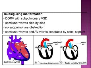 Guideline DORV
subpulmonary VSD
Taussig-Bing malformation:
• DORV with subpulmonary VSD
• semilunar valves side-by-side
• no subpulmonary obstruction
• semilunar valves and AV-valves separated by conal septum
 