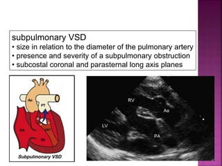 Guideline DORV
subpulmonary VSD
• size in relation to the diameter of the pulmonary artery
• presence and severity of a subpulmonary obstruction
• subcostal coronal and parasternal long axis planes
 