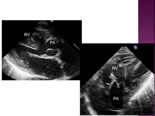 Guideline DORV
subpulmonary VSD
RV
RV
PA
PA
 