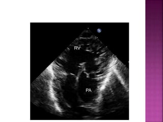 Guideline DORV
subpulmonary VSD
PA
RV
 