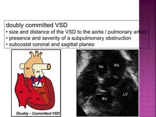 Guideline DORV
doubly committed VSD
• size and distance of the VSD to the aorta / pulmonary artery
• presence and severity of a subpulmonary obstruction
• subcostal coronal and sagittal planes
 