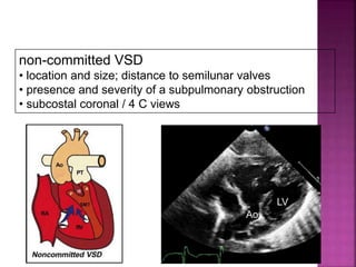 Guideline DORV
non-committed VSD
• location and size; distance to semilunar valves
• presence and severity of a subpulmonary obstruction
• subcostal coronal / 4 C views
LV
Ao
 