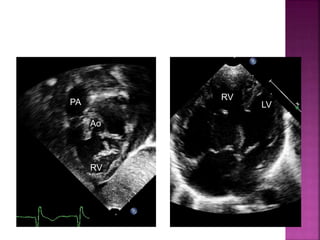 Ao
PA
RV
RV
LV
Guideline DORV
non-committed VSD
 