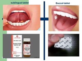 Sublingually Dosage forms | PPTX