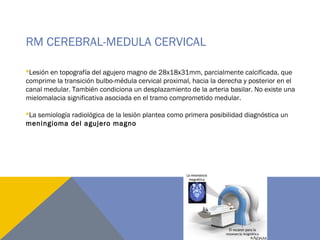 RM CEREBRAL-MEDULA CERVICAL
Lesión en topografía del agujero magno de 28x18x31mm, parcialmente calcificada, que
comprime la transición bulbo-médula cervical proximal, hacia la derecha y posterior en el
canal medular. También condiciona un desplazamiento de la arteria basilar. No existe una
mielomalacia significativa asociada en el tramo comprometido medular.
La semiología radiológica de la lesión plantea como primera posibilidad diagnóstica un
meningioma del agujero magno
 