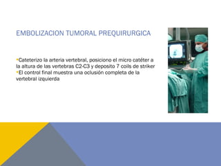 EMBOLIZACION TUMORAL PREQUIRURGICA
Cateterizo la arteria vertebral, posiciono el micro catéter a
la altura de las vertebras C2-C3 y deposito 7 coils de striker
El control final muestra una oclusión completa de la
vertebral izquierda
 