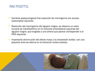 RM POSTTO.
 Cambios postquirúrgicos tras resección de meningioma con acceso
suboccipital izquierdo.
 Resección del meningioma del agujero magno, se observa un resto
tumoral de 14x10x23mm en la vertiente anterolateral izquierda del
agujero magno, que engloba a una arteria que parece corresponder a la
PICA izquierda
 Importante disminución del efecto masa y la compresión bulbar, con una
pequeña área de edema en la transición bulbo-medular.
 