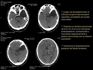 Imagen de densidad similar al
LCR que ocupa la fosa temporal
izquierda, compatible con quiste
aracnoideo.
 Presenta un tamaño aproximado
de 5,5 x 4 x 4,5 cm en los planos
anteroposterior, craneocaudal y
transverso respectivamente y
parece comunicado con la cisterna
supraselar.
 Condiciona el desplazamiento
posterior del lóbulo temporal.
 