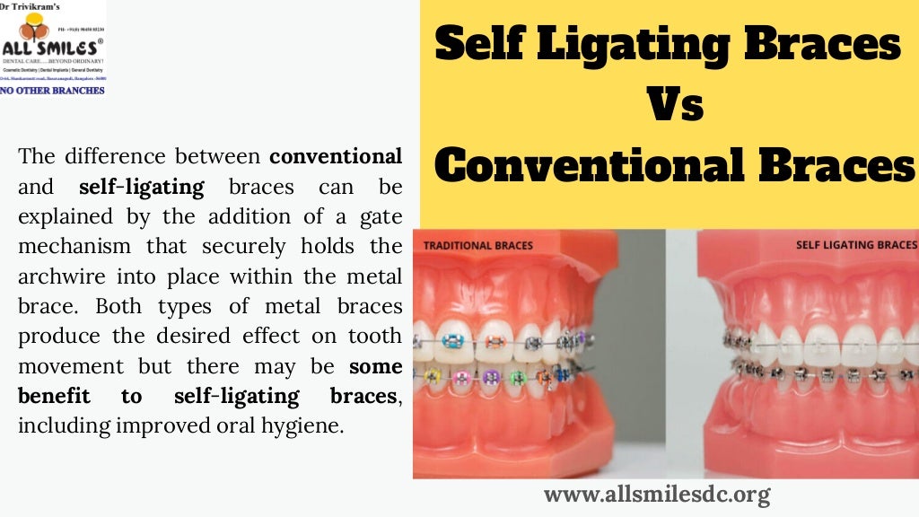 Do Self Ligating Braces Works Better Than Regular Conventional Braces