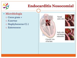 Endocarditis Nosocomial

 Microbiología
    Cocos gram +
    S.aureus
    Staphylococcus C(-)
    Enterococos
 
