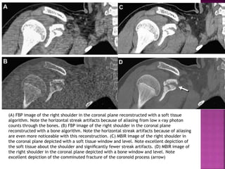 Dose reduction technique in ct scan | PPTX