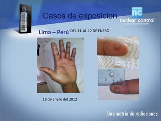 18 de Enero del 2012
Lima – Perú DEL 11 AL 12 DE ENERO
Casos de exposicion
 