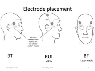 Placement Of Electrodes In Electroconvulsive Therapy