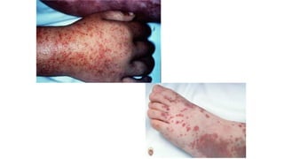 Comprehensive Overview of Bleeding Disorders and Hemostasis Mechanisms ...