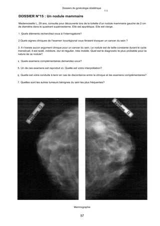 Dossiers de gynécologie obstétrique
X J(
DOSSIER N°15 : Un nodule mammaire
Mademoiselle L, 29 ans, consulte pour découverte lors de la toilette d'un nodule mammaire gauche de 2 cm
de diamètre dans le quadrant supéroexterne. Elle est apyrétique. Elle est vierge.
1. Quels éléments recherchez-vous à l'interrogatoire?
2 Quels signes cliniques de l'examen locorégional vous feraient évoquer un cancer du sein ?
3. II n'existe aucun argument clinique pour un cancer du sein. Le nodule est de taille constante durant le cycle
menstruel, il est isolé, indolore, dur et régulier, très mobile. Quel est le diagnostic le plus probable pour la
nature de ce nodule?
4. Quels examens complémentaires demandez-vous?
5. Un de ces examens est reproduit ici. Quelle est votre interprétation?
6. Quelle est votre conduite à tenir en cas de discordance entre la clinique et les examens complémentaires?
7. Quelles sont les autres tumeurs bénignes du sein les plus fréquentes?
Mammographie
57
 