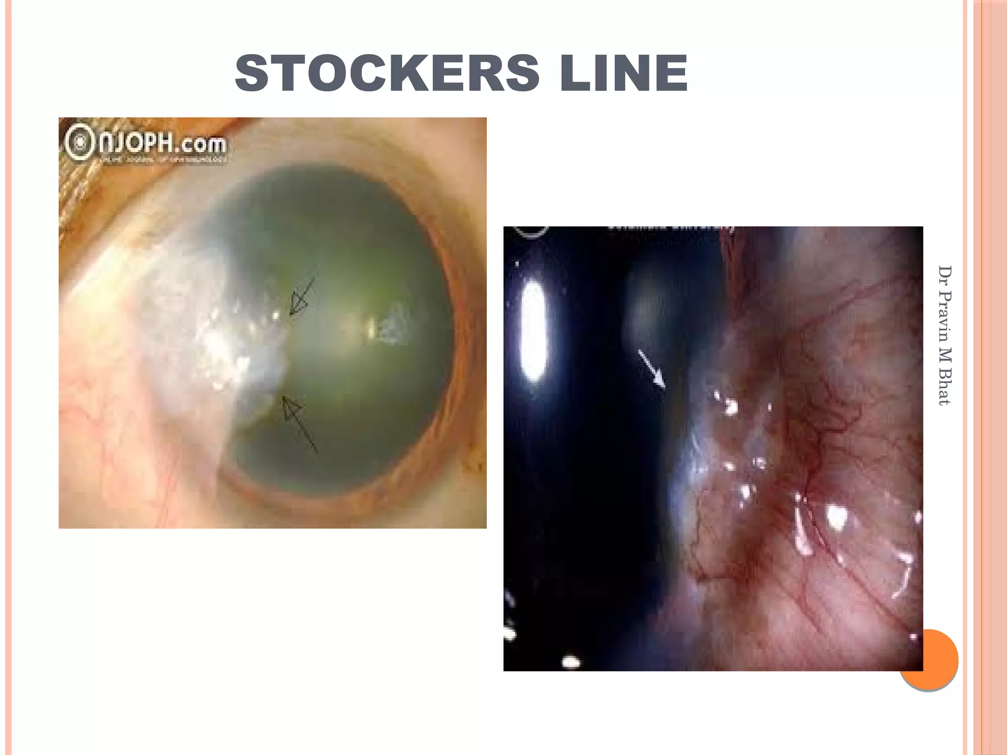 Dots spots lines_and_rings_in_ophthalmology | PDF | Eye and Vision ...