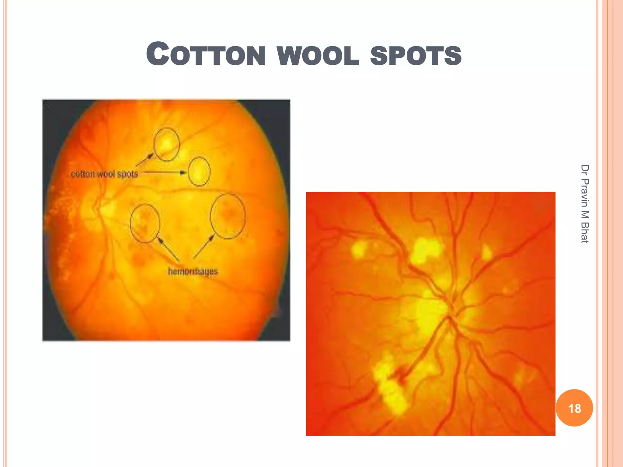 Dots Spots Lines And Rings In Ophthalmology PPTX dots-spots-lines-and-rings-in-ophthalmology-pptx