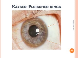 Dots spots lines and rings in ophthalmology | PPTX