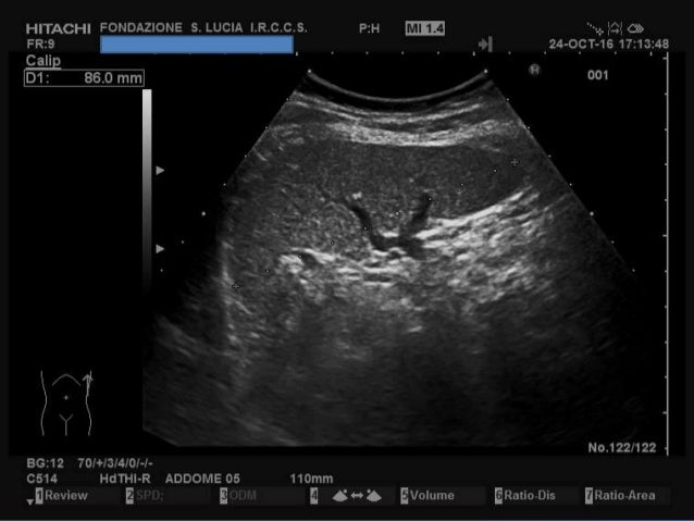 Ecografia Alla Milza