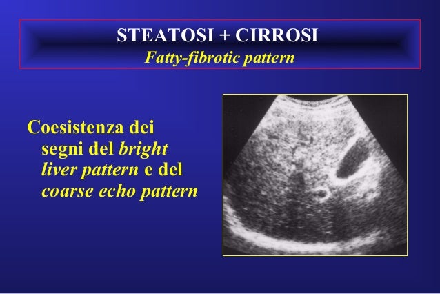 Epatopatie Diffuse Ipertensione Portale