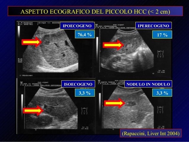 Fegato Lesioni Focali