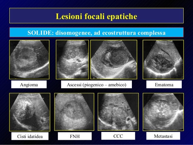 Fegato Lesioni Focali