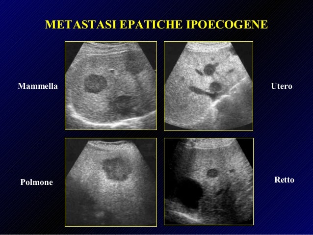 Fegato Lesioni Focali
